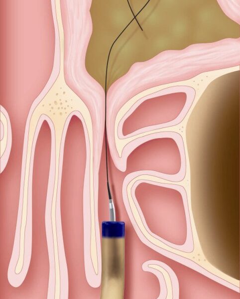 Step 1: A guide wire and balloon catheter are inserted into the inflamed sinus.